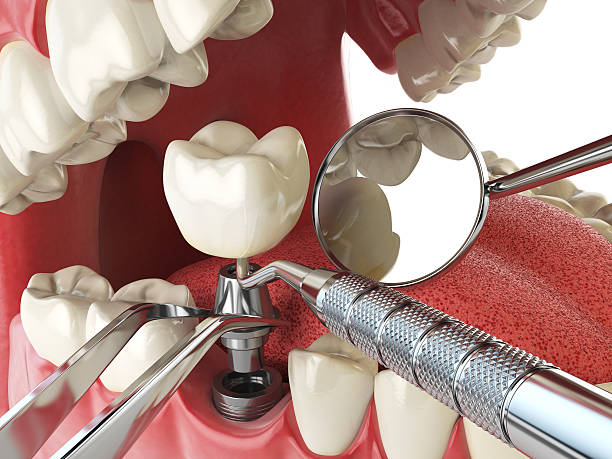 Best Emergency Dentist for Knocked-Out Tooth in Englewood, TN